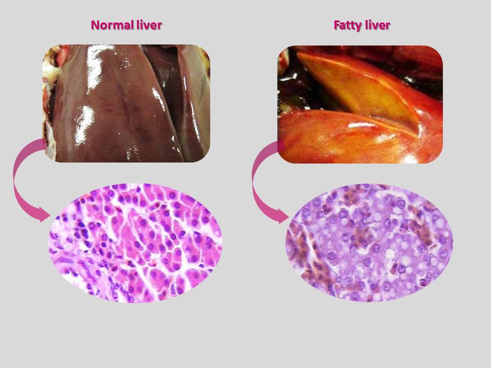 Fatty liver syndrome, FLS